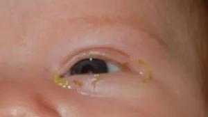 Blocked tear ducts in Infants